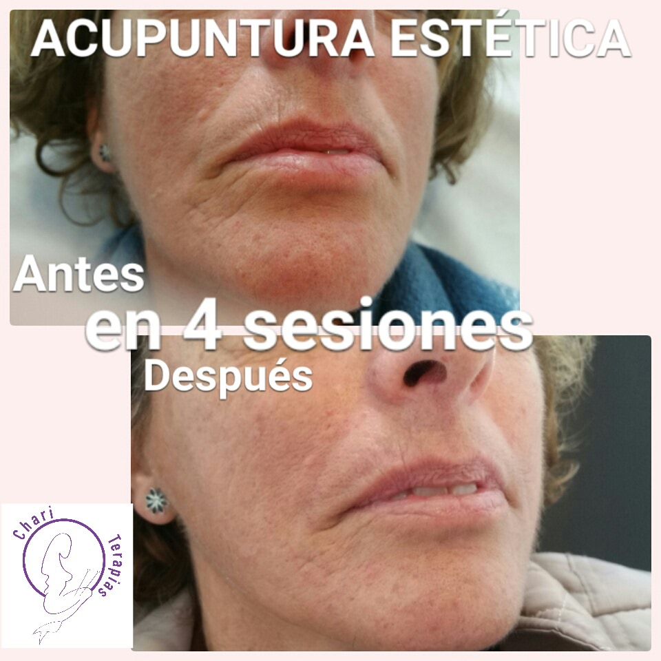 Acupuntura estética facial y corporal: Terapias Naturales de Charo Terapias Natura en Cádiz y Conil Acupuntura estética facial y corporal: Terapias Naturales de Charo Terapias Natura en Cádiz y Conil