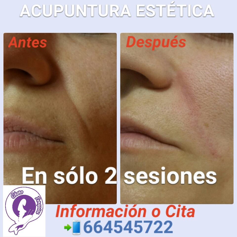 Acupuntura estética facial y corporal: Terapias Naturales de Charo Terapias Natura en Cádiz y Conil Acupuntura estética facial y corporal: Terapias Naturales de Charo Terapias Natura en Cádiz y Conil