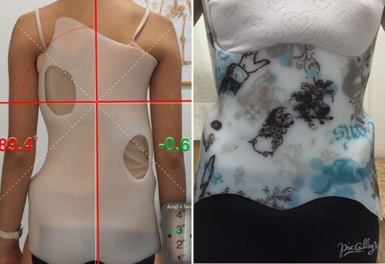 Nuevos diseños para corses de tratamiento de escoliosis y cifosis