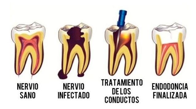 TRATAMIENTO DE CONDUCTOS TRATAMIENTO DE CONDUCTOS