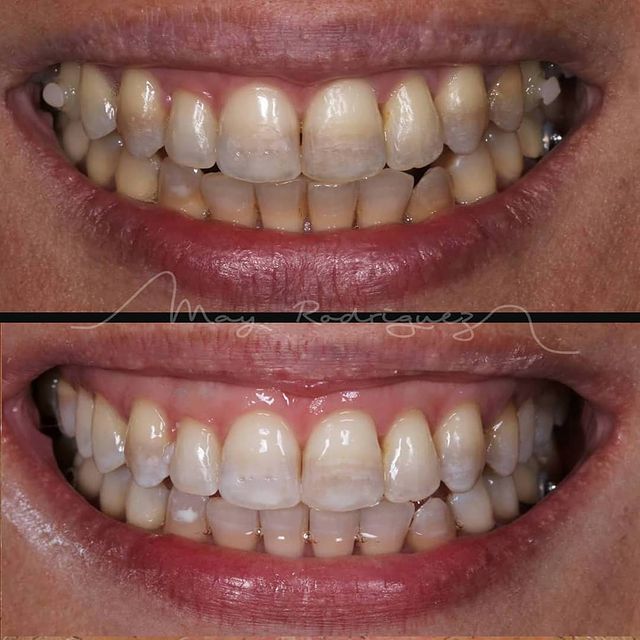 May Rodríguez Villamizar: Nuestros Tratamientos de Clínica Dental Rafael Menéndez May Rodríguez Villamizar: Nuestros Tratamientos de Clínica Dental Rafael Menéndez