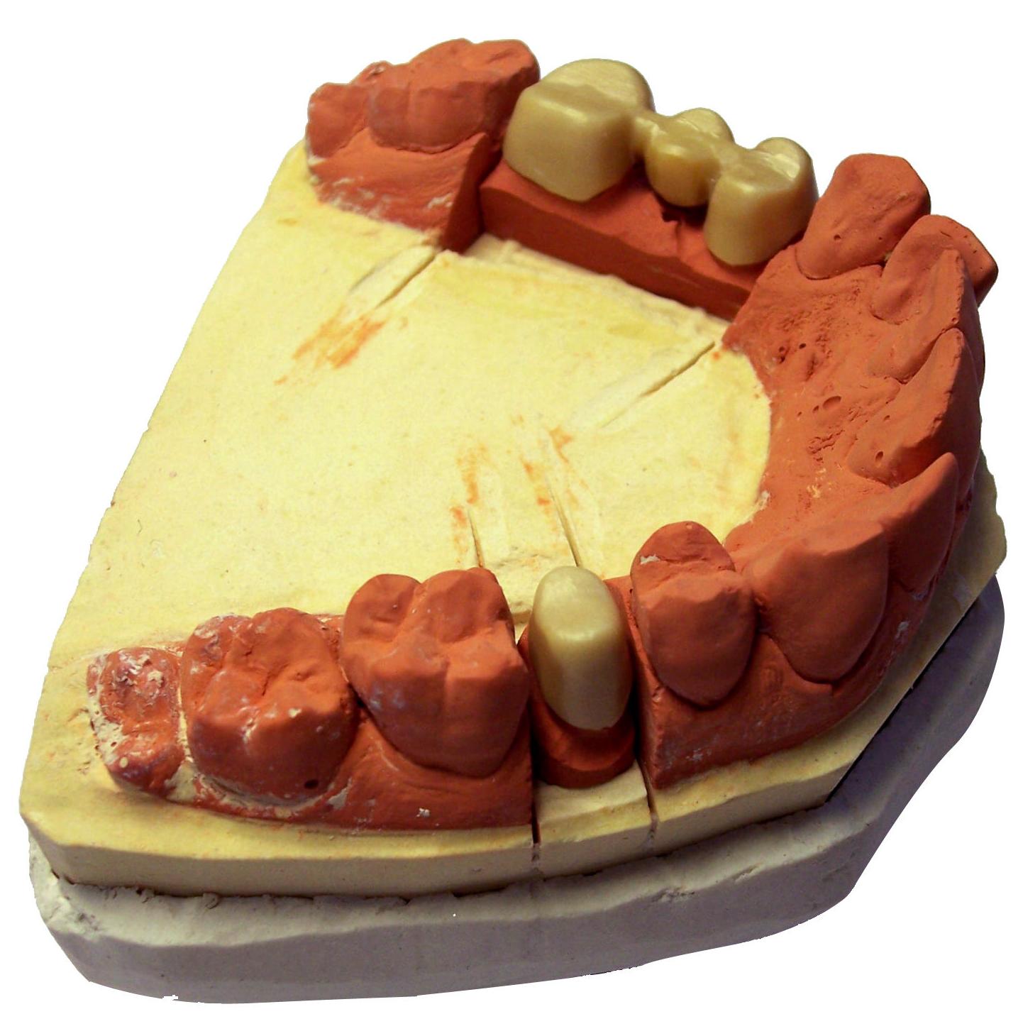 Prótesis fija y removible: Tratamientos de Clínica Dental Rafael Menendez Prótesis fija y removible: Tratamientos de Clínica Dental Rafael Menendez