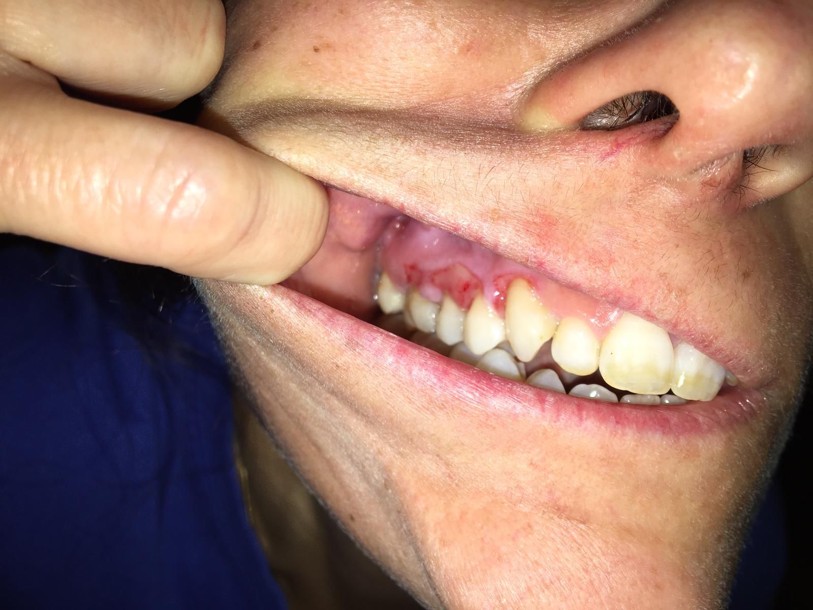 Estomatitis herpética antes de tratamiento en Clínica Dental Dr. Rafael Menéndez Estomatitis herpética antes de tratamiento en Clínica Dental Dr. Rafael Menéndez