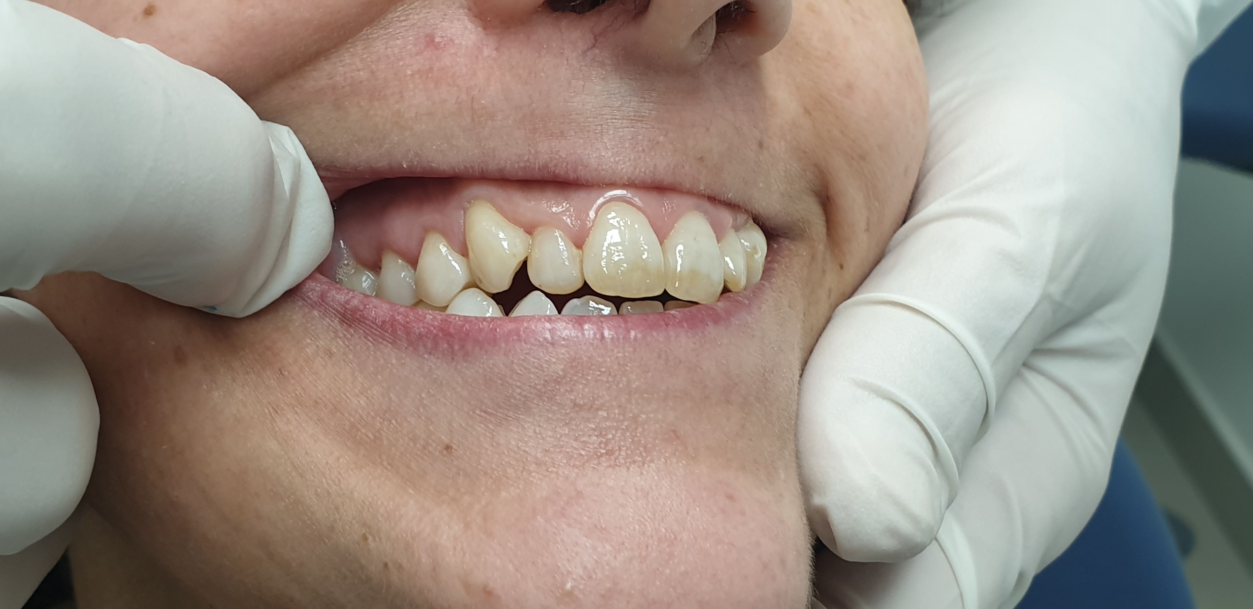 Después del tratamiento Estomatitis herpética Clínica Dental Dr. Rafael Menéndez Después del tratamiento Estomatitis herpética Clínica Dental Dr. Rafael Menéndez