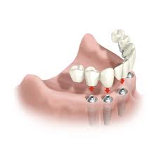 implantología y prótesis implantología y prótesis