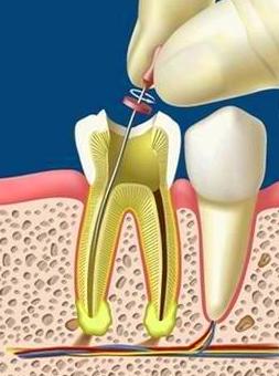 Endodoncias (Extirpación del nervio dentario): Tratamientos de Clínica Dental Les Mèlies Endodoncias (Extirpación del nervio dentario): Tratamientos de Clínica Dental Les Mèlies