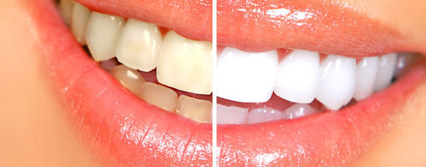 Blanqueamientos: Tratamientos de Clínica Dental Les Mèlies Blanqueamientos: Tratamientos de Clínica Dental Les Mèlies