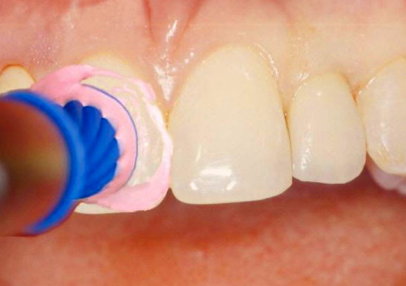 Higienes bucodentales: Tratamientos de Clínica Dental Les Mèlies Higienes bucodentales: Tratamientos de Clínica Dental Les Mèlies