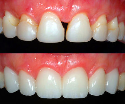 Carillas: Tratamientos de Clínica Dental Les Mèlies Carillas: Tratamientos de Clínica Dental Les Mèlies