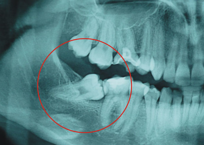 Cirugías Maxilofaciales: Tratamientos de Clínica Dental Les Mèlies Cirugías Maxilofaciales: Tratamientos de Clínica Dental Les Mèlies