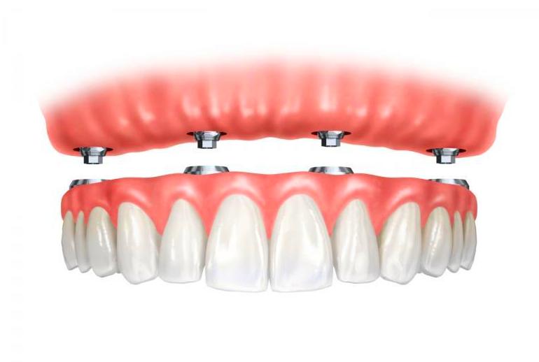 Dentaduras sobre implantes: Tratamientos de Clínica Dental Les Mèlies Dentaduras sobre implantes: Tratamientos de Clínica Dental Les Mèlies