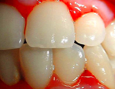Raspados subgingivales.: Tratamientos de Clínica Dental Les Mèlies Raspados subgingivales.: Tratamientos de Clínica Dental Les Mèlies