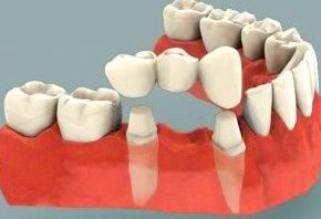 Prótesis Fijas : Tratamientos de Clínica Dental Les Mèlies Prótesis Fijas : Tratamientos de Clínica Dental Les Mèlies