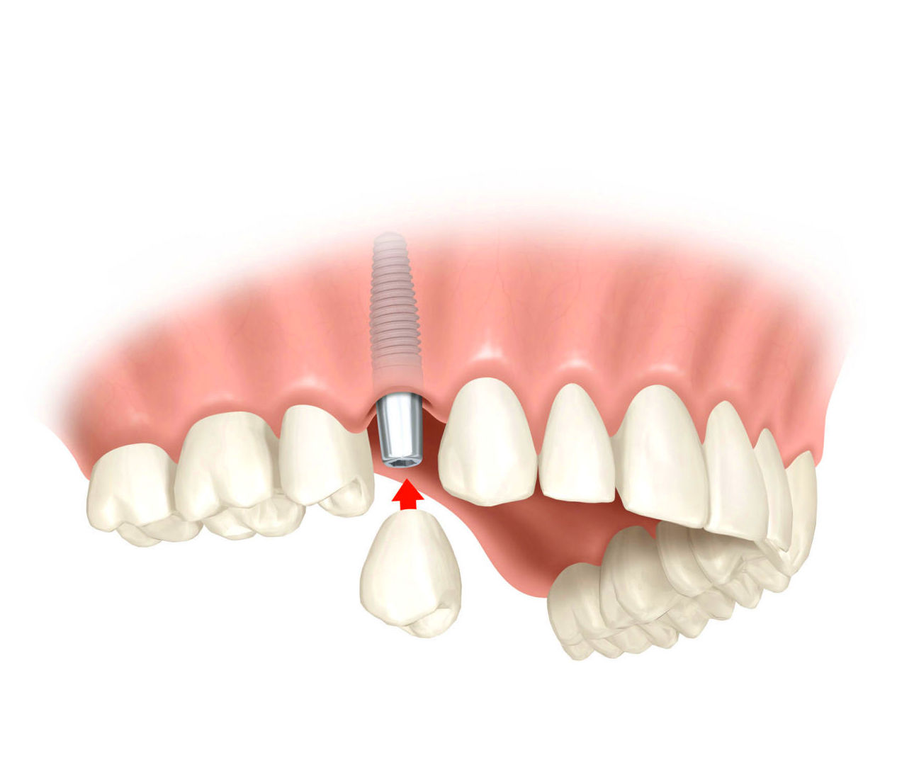 Fundas sobre implantes: Tratamientos de Clínica Dental Les Mèlies Fundas sobre implantes: Tratamientos de Clínica Dental Les Mèlies