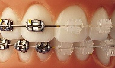Ortodoncia fija metálica y estética.: Tratamientos de Clínica Dental Les Mèlies Ortodoncia fija metálica y estética.: Tratamientos de Clínica Dental Les Mèlies