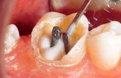 Reconstrucciones: Tratamientos de Clínica Dental Les Mèlies Reconstrucciones: Tratamientos de Clínica Dental Les Mèlies