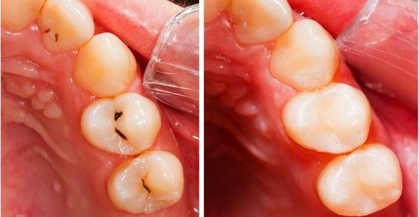Obturaciones (Empastes): Tratamientos de Clínica Dental Les Mèlies Obturaciones (Empastes): Tratamientos de Clínica Dental Les Mèlies
