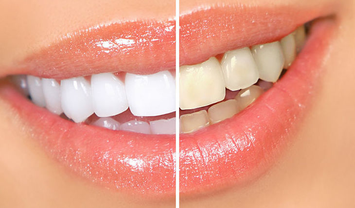 Blanqueamiento dental: Catálogo de Centro de Salud Dental FamilDent Blanqueamiento dental: Catálogo de Centro de Salud Dental FamilDent