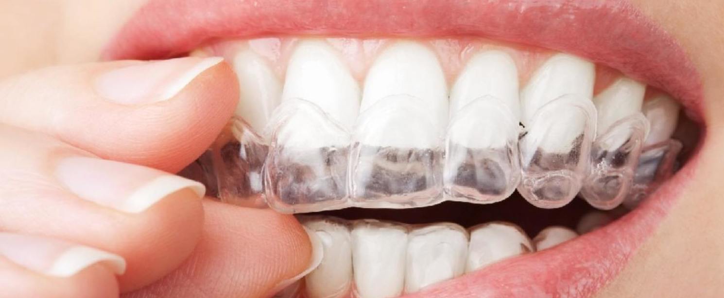 Férulas de descarga: Catálogo de Centro de Salud Dental FamilDent Férulas de descarga: Catálogo de Centro de Salud Dental FamilDent