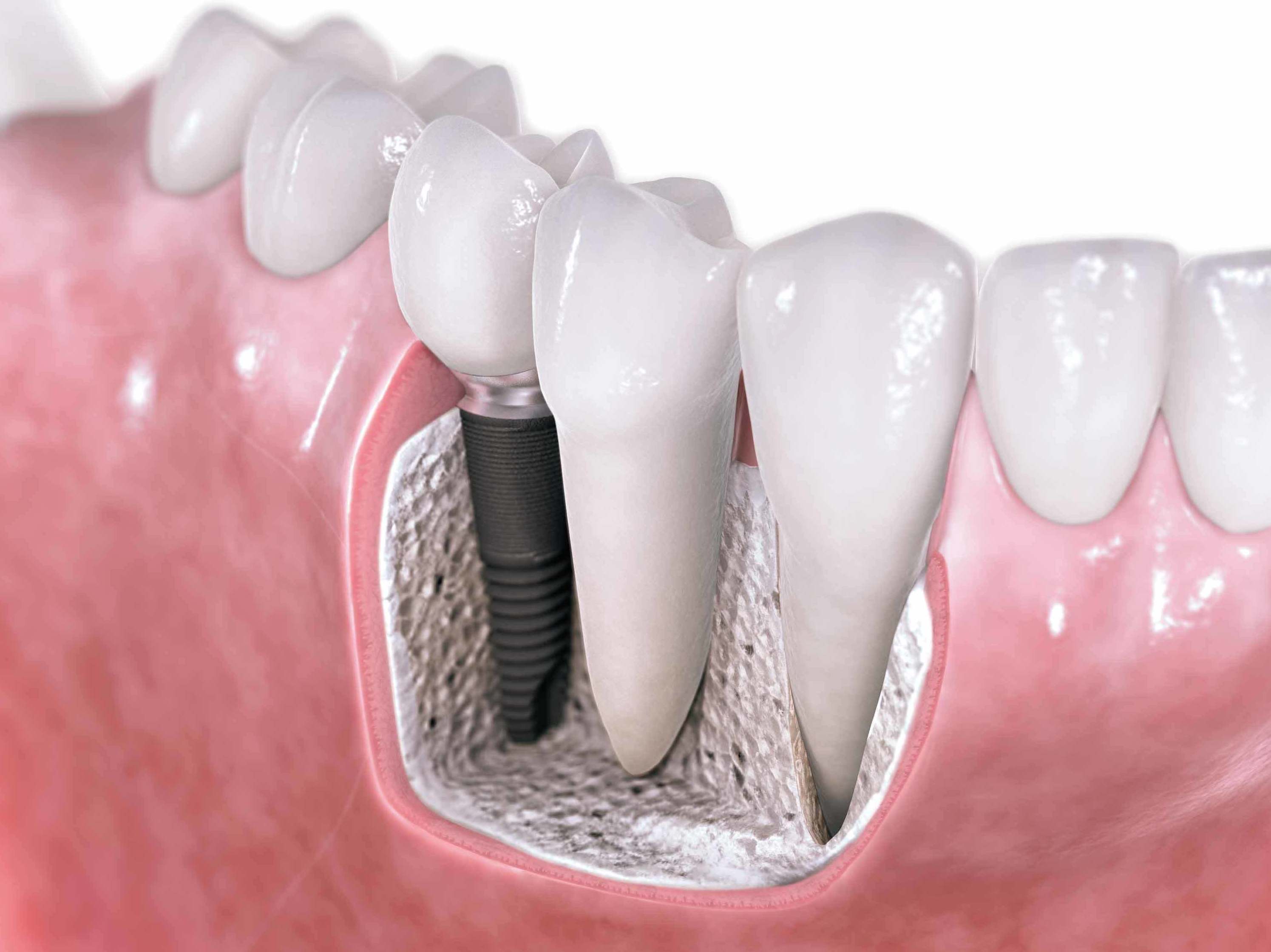 Implantología: Catálogo de Centro de Salud Dental FamilDent Implantología: Catálogo de Centro de Salud Dental FamilDent