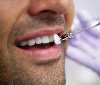Carillas estéticas: Catálogo de Centro de Salud Dental FamilDent Carillas estéticas: Catálogo de Centro de Salud Dental FamilDent