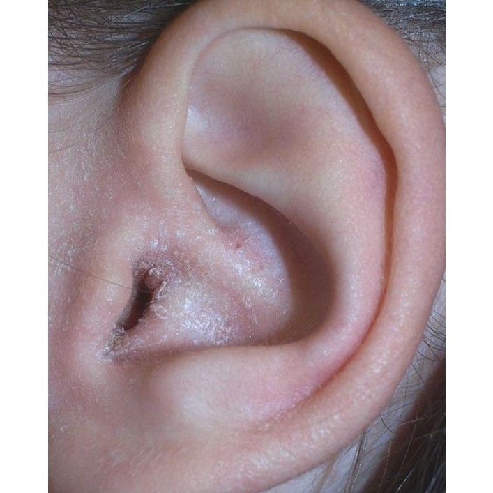 Otitis: Servicios de Miguel Ángel Ojeda Rodríguez Otitis: Servicios de Miguel Ángel Ojeda Rodríguez