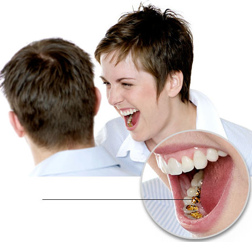 Los brackets del Sistema Incognito™ se colocan detrás de los dientes.Verdaderamente invisible Los brackets del Sistema Incognito™ se colocan detrás de los dientes.Verdaderamente invisible