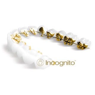 Ortodoncia lingual incógnito: Tratamientos y Aparatos de Dra. Amaia Goena Ortodoncia lingual incógnito: Tratamientos y Aparatos de Dra. Amaia Goena