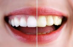 Blanqueamiento Dental: Servicios de Clínica Dental Box Serrano Blanqueamiento Dental: Servicios de Clínica Dental Box Serrano