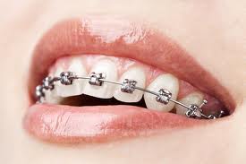 Braquets metalicos o ceramicos: Servicios de Clínica Dental Box Serrano Braquets metalicos o ceramicos: Servicios de Clínica Dental Box Serrano