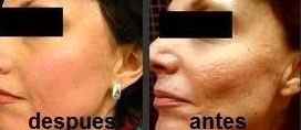 Eliminación de Manchas y Rejuvenecimiento Facial Alicante Eliminación de Manchas y Rejuvenecimiento Facial Alicante