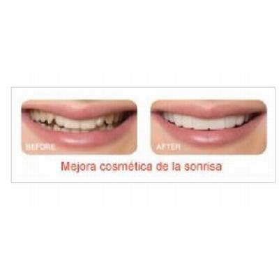 Snap-on-Smile: Especialidades de Clínicas Dental Máster RJ Alamillo Snap-on-Smile: Especialidades de Clínicas Dental Máster RJ Alamillo