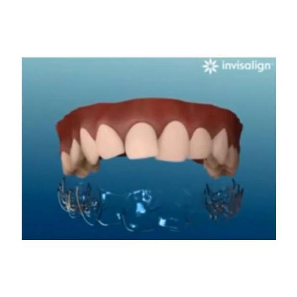 Invisalign: Especialidades de Clínicas Dental Máster RJ Alamillo Invisalign: Especialidades de Clínicas Dental Máster RJ Alamillo