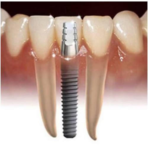 Implantología Dental: Especialidades de Clínicas Dental Máster RJ Alamillo Implantología Dental: Especialidades de Clínicas Dental Máster RJ Alamillo
