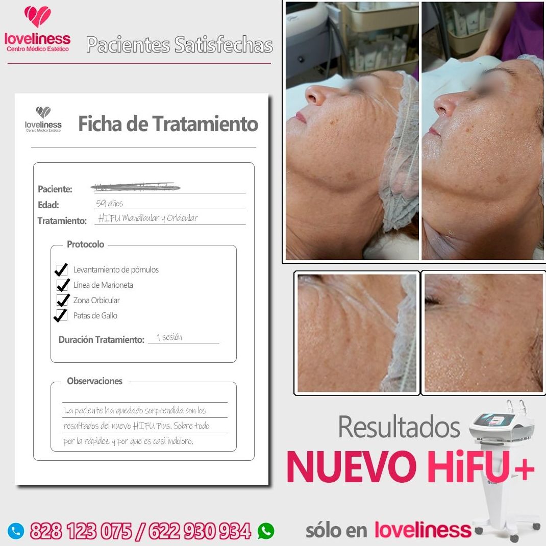 HIFU (Lifting facial sin cirugía): Tratamientos de estética de Clínica Estética Loveliness HIFU (Lifting facial sin cirugía): Tratamientos de estética de Clínica Estética Loveliness