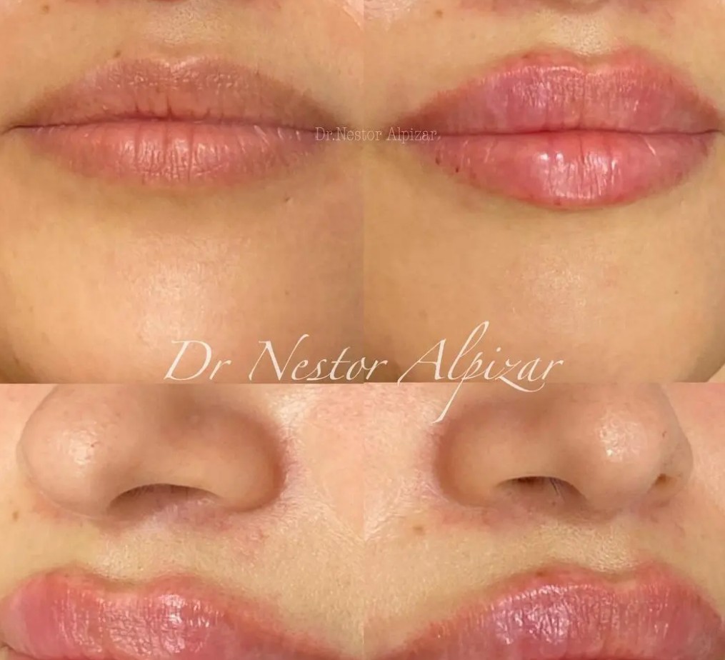 Relleno de ácido hialurónico: Tratamientos de estética de Clínica Estética Loveliness Relleno de ácido hialurónico: Tratamientos de estética de Clínica Estética Loveliness