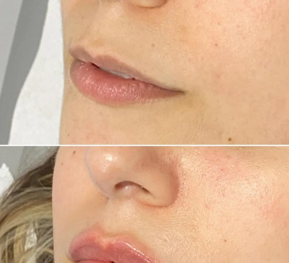 Relleno de ácido hialurónico: Tratamientos de estética de Clínica Estética Loveliness Relleno de ácido hialurónico: Tratamientos de estética de Clínica Estética Loveliness
