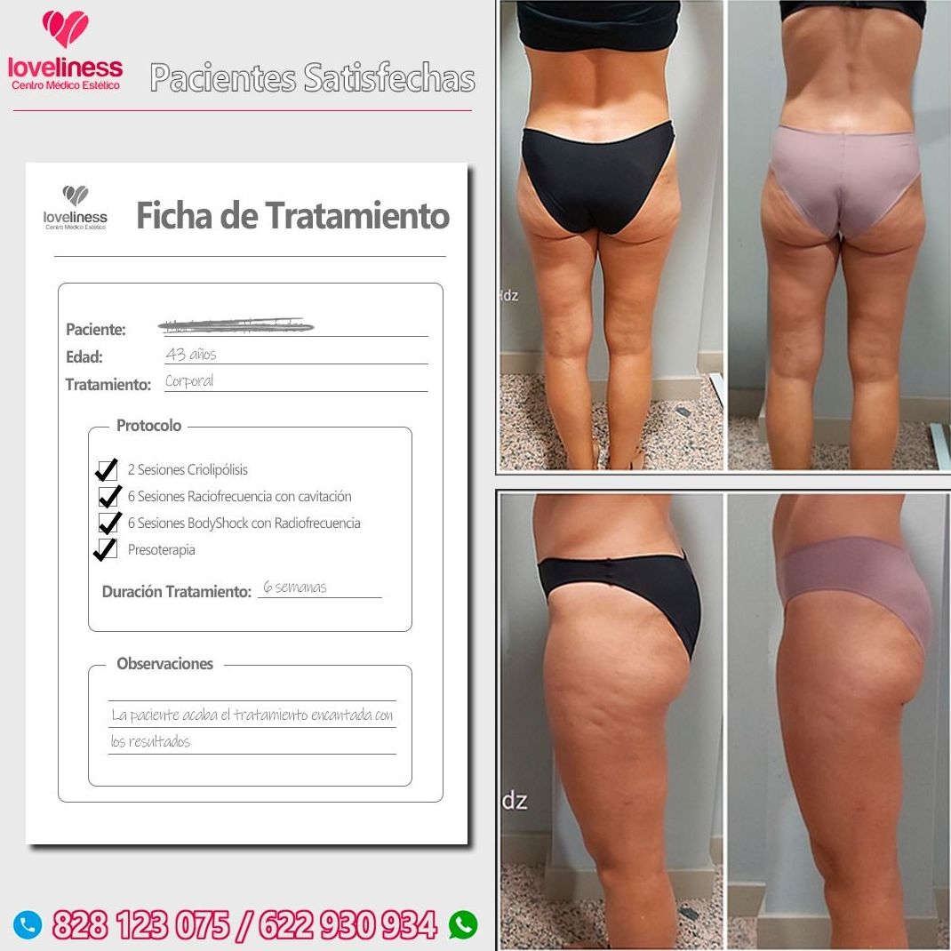 Tratamiento celulitis (solicita una valoración gratuita): Tratamientos de estética de Clínica Estética Loveliness Tratamiento celulitis (solicita una valoración gratuita): Tratamientos de estética de Clínica Estética Loveliness