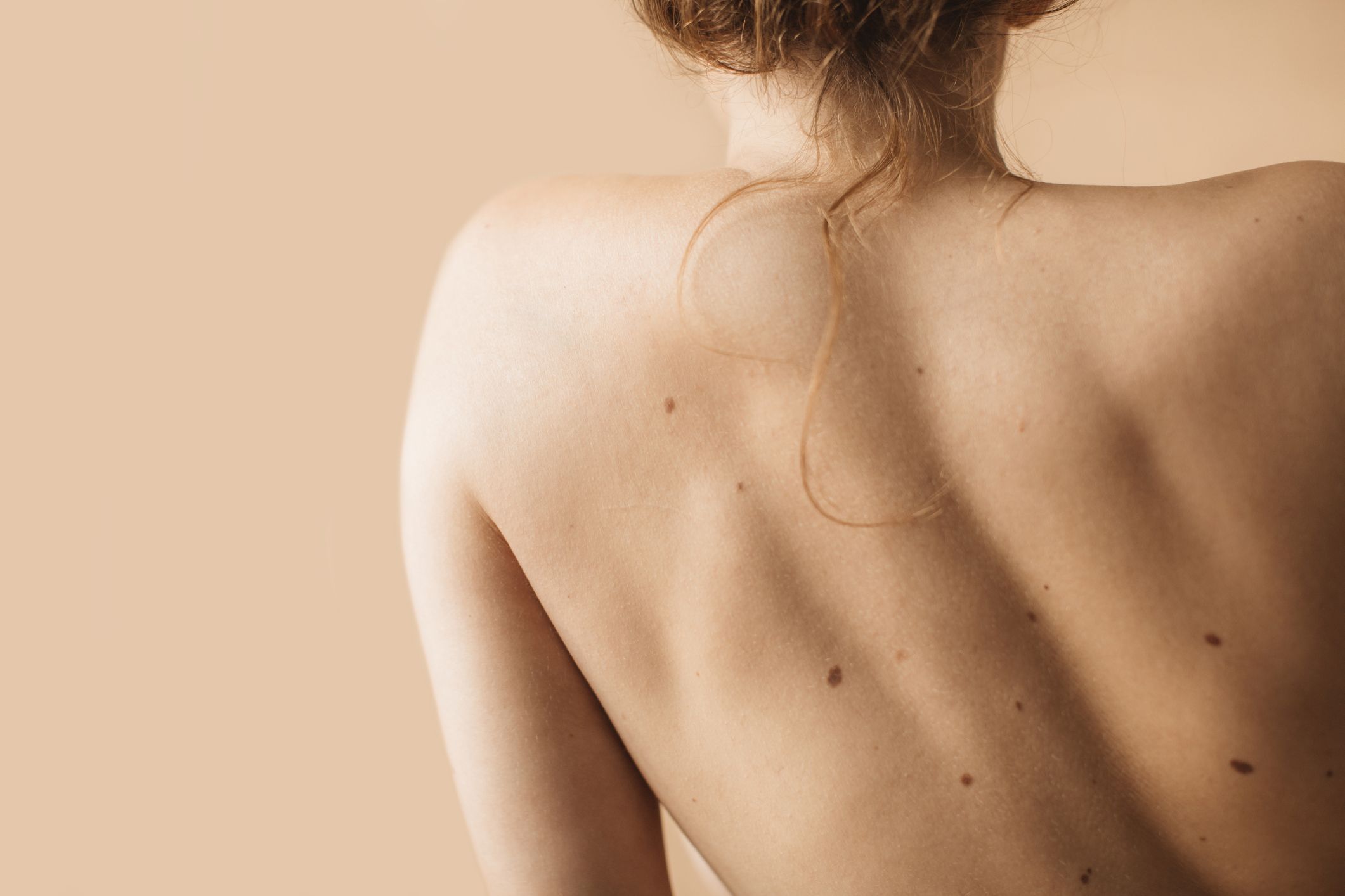 Laser Plexr. Laser de plasma. (Blefaroplastia, cicatrices, verrugas y lunar: Tratamientos de estética de Clínica Estética Loveliness Laser Plexr. Laser de plasma. (Blefaroplastia, cicatrices, verrugas y lunar: Tratamientos de estética de Clínica Estética Loveliness