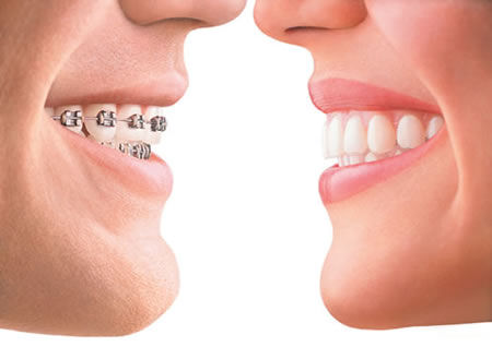 Invisalign Invisalign