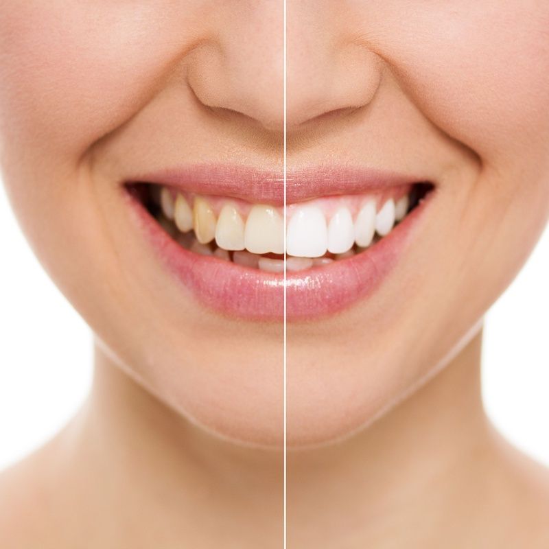 Estética Dental y Restauradora - Dra. Argumosa: Servicios de Clínica Dental Mas Camarena