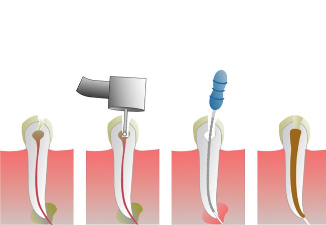 Endodoncia: Servicios de Clínica Dental Mas Camarena