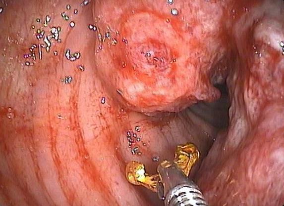 Biopsia de tumor do intestino Biopsia de tumor do intestino