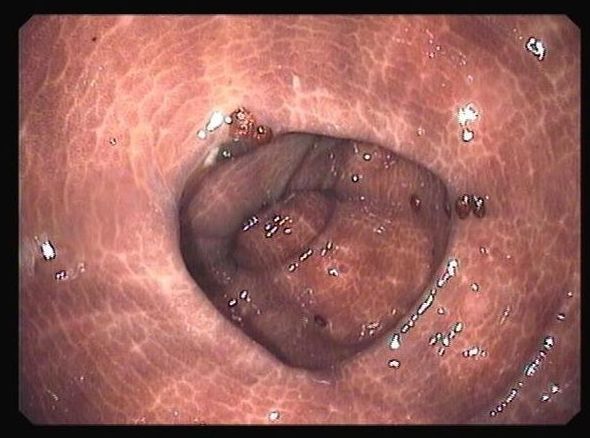 Limpeza intestinal - Colonoscopia a realizar no período da tarde - Após 17H: Preparações para exame de J. E. Pina Cabral - Clínica e Endoscopia Digestiva Limpeza intestinal - Colonoscopia a realizar no período da tarde - Após 17H: Preparações para exame de J. E. Pina Cabral - Clínica e Endoscopia Digestiva
