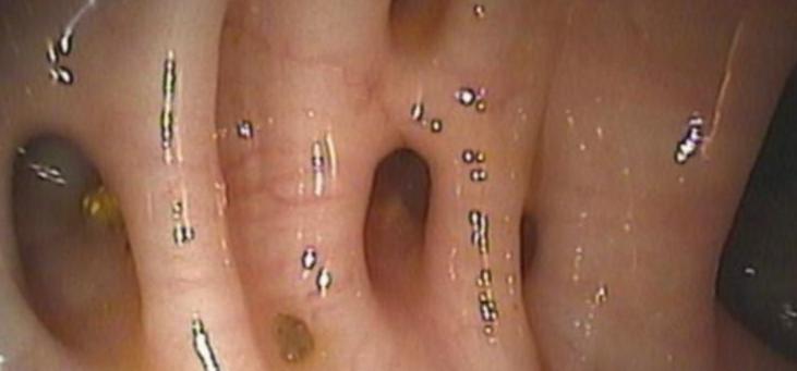 Divertículos do intestino grosso Divertículos do intestino grosso
