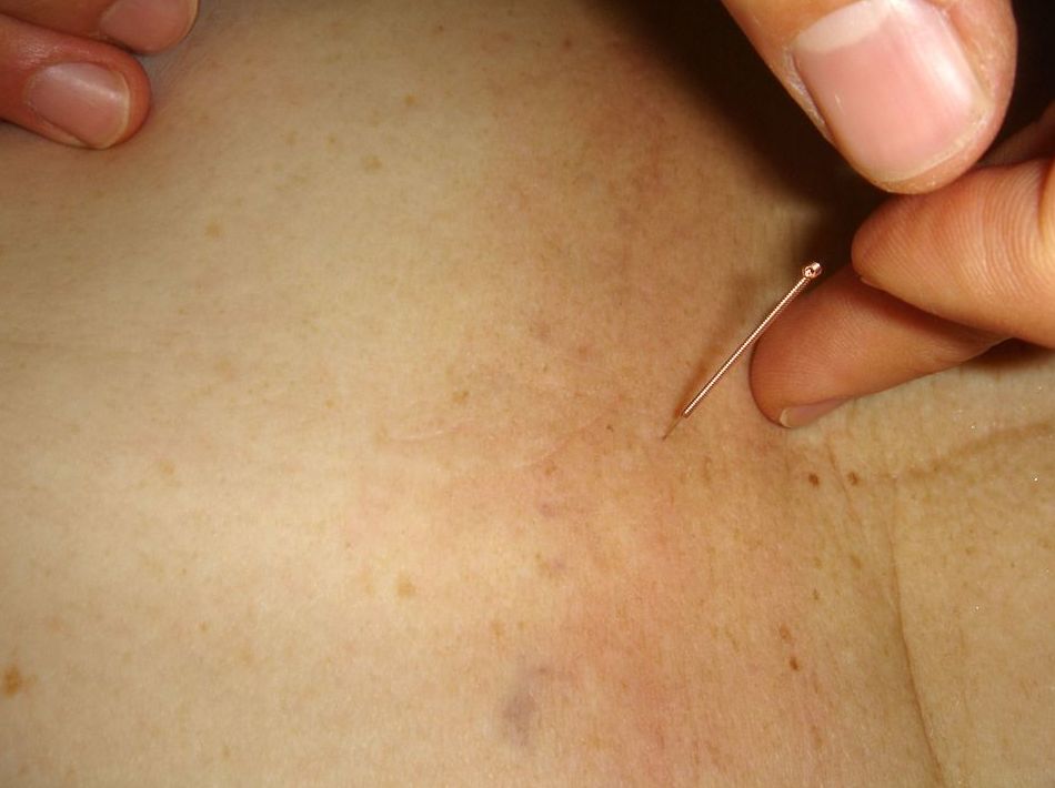 Acupuntura: Tratamientos de Conchi Fernández Abad Acupuntura: Tratamientos de Conchi Fernández Abad