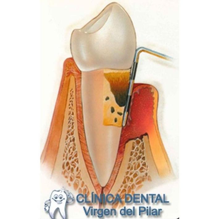 Periodoncia: Tratamientos de Clínica Dental Virgen del Pilar Periodoncia: Tratamientos de Clínica Dental Virgen del Pilar