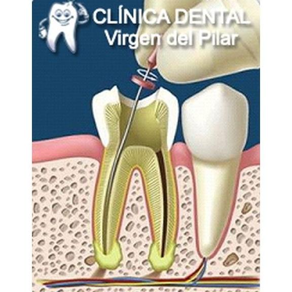 Endodoncia: Tratamientos de Clínica Dental Virgen del Pilar Endodoncia: Tratamientos de Clínica Dental Virgen del Pilar