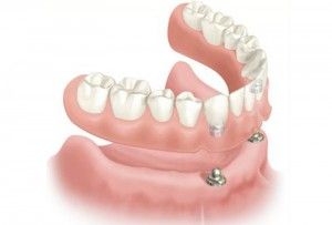 Implantes dentales: Tratamientos de Clínica Dental Virgen del Pilar Implantes dentales: Tratamientos de Clínica Dental Virgen del Pilar