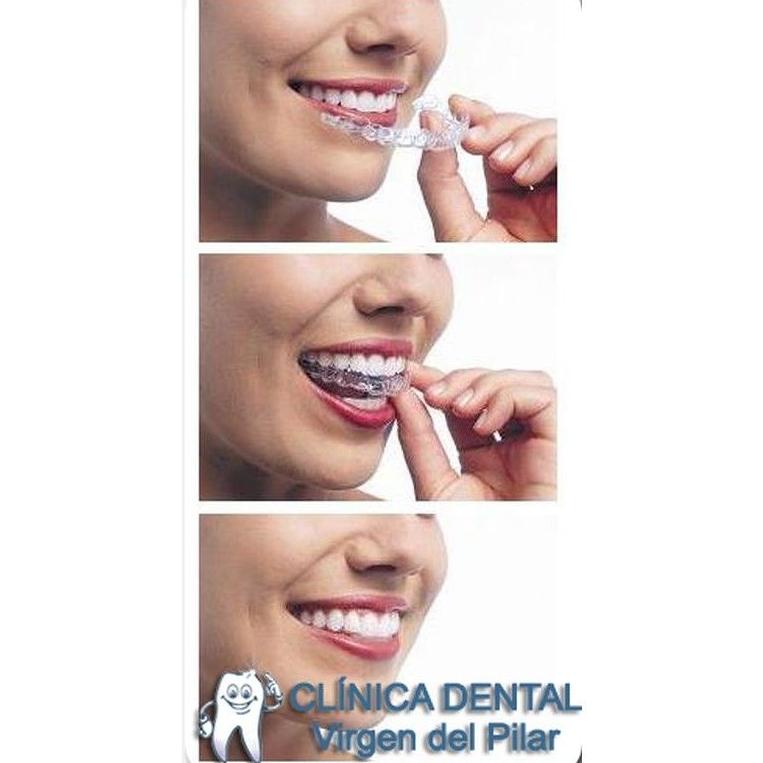 Ortodoncia invisible: Tratamientos de Clínica Dental Virgen del Pilar Ortodoncia invisible: Tratamientos de Clínica Dental Virgen del Pilar